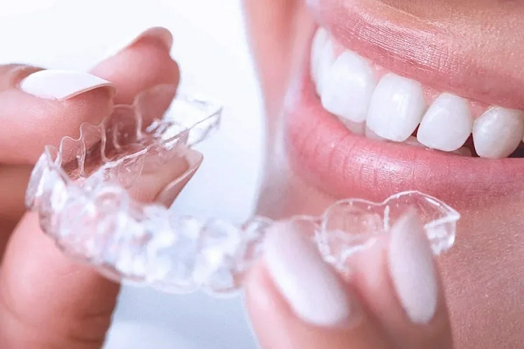 Что такое элайнеры для выравнивания зубов и их применение