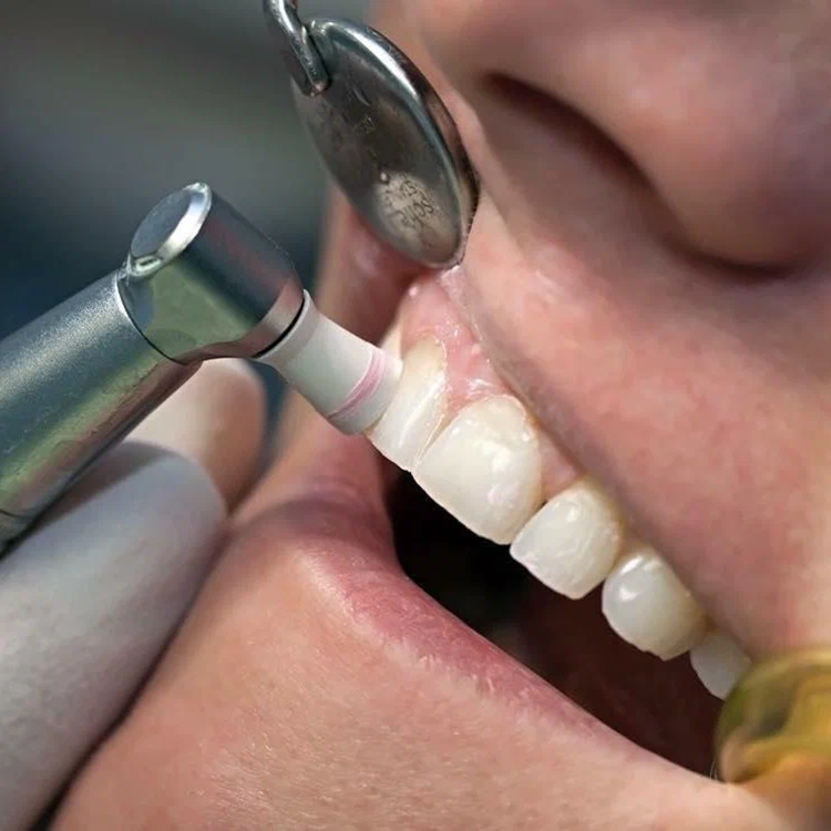 Как выполняется полировка зубов и несколько рекомендаций